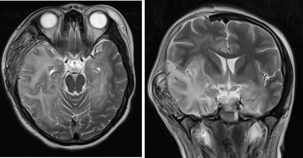 Herpes Simplex Encephalitis Radiology Cases Herpes Simplex Encephalitis Radiology Cases