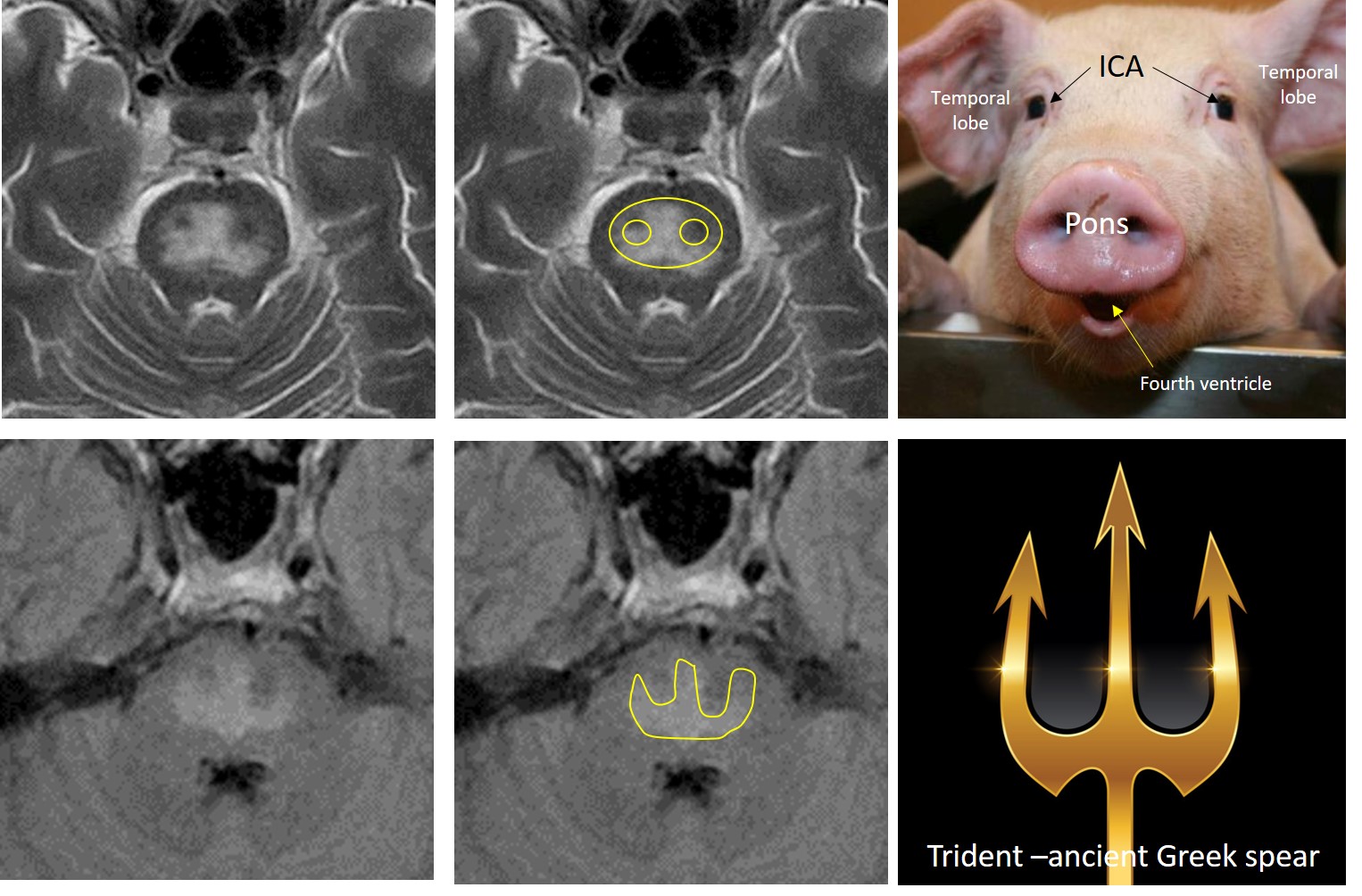 Piglet and trident signs in osmotic demyelination syndrome Radiology