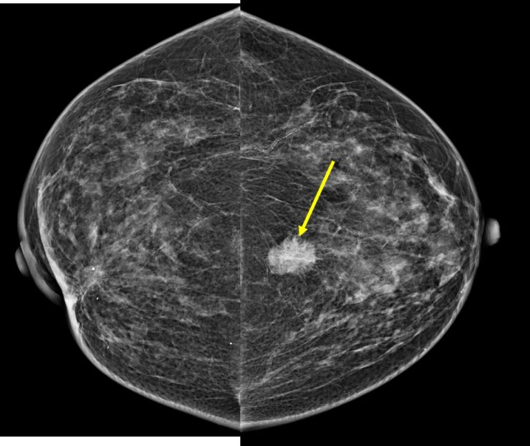 Metachronous breast cancer Radiology Cases
