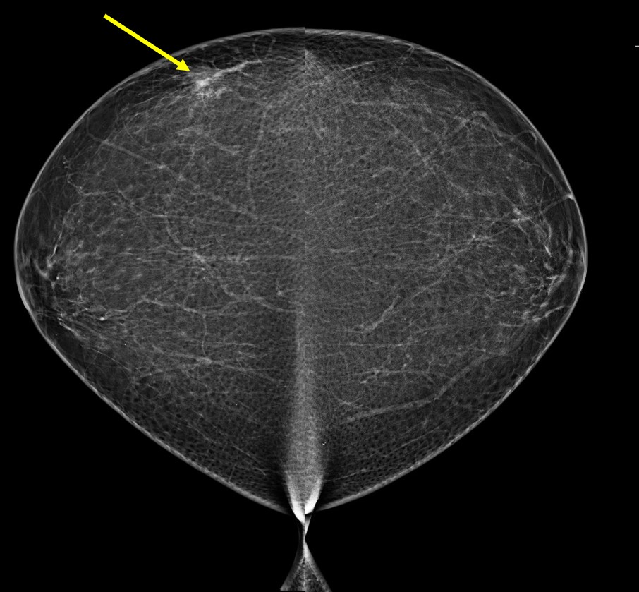 Tomosynthesis In Fatty Breasts Radiology Cases