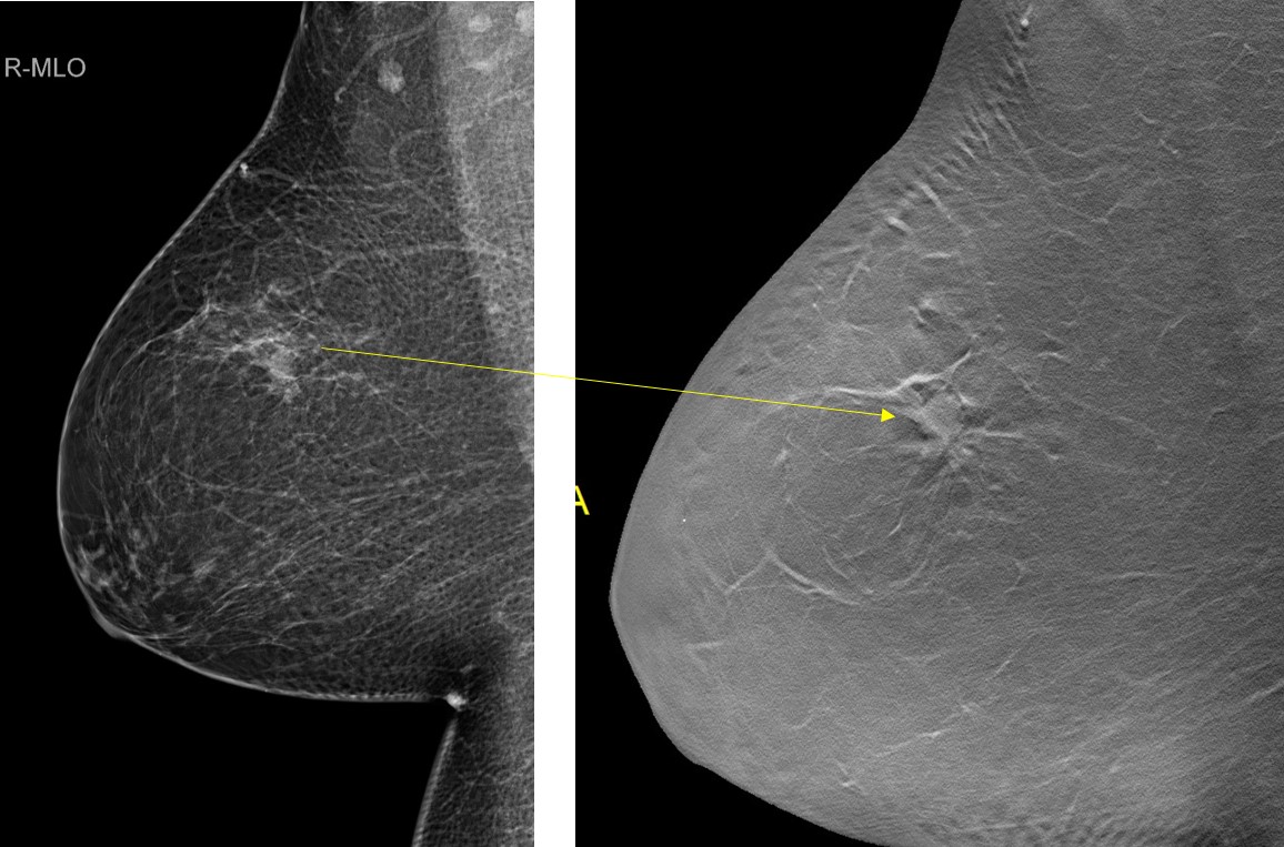 Tomosynthesis In Fatty Breasts Radiology Cases