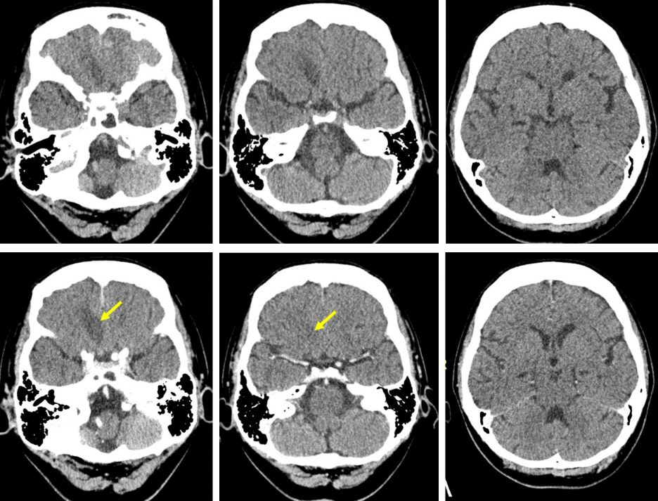 intracranial-extension-of-fungal-sinusitis-intracranial-extension-of