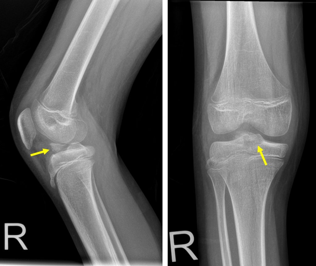 avulsion fracture knee