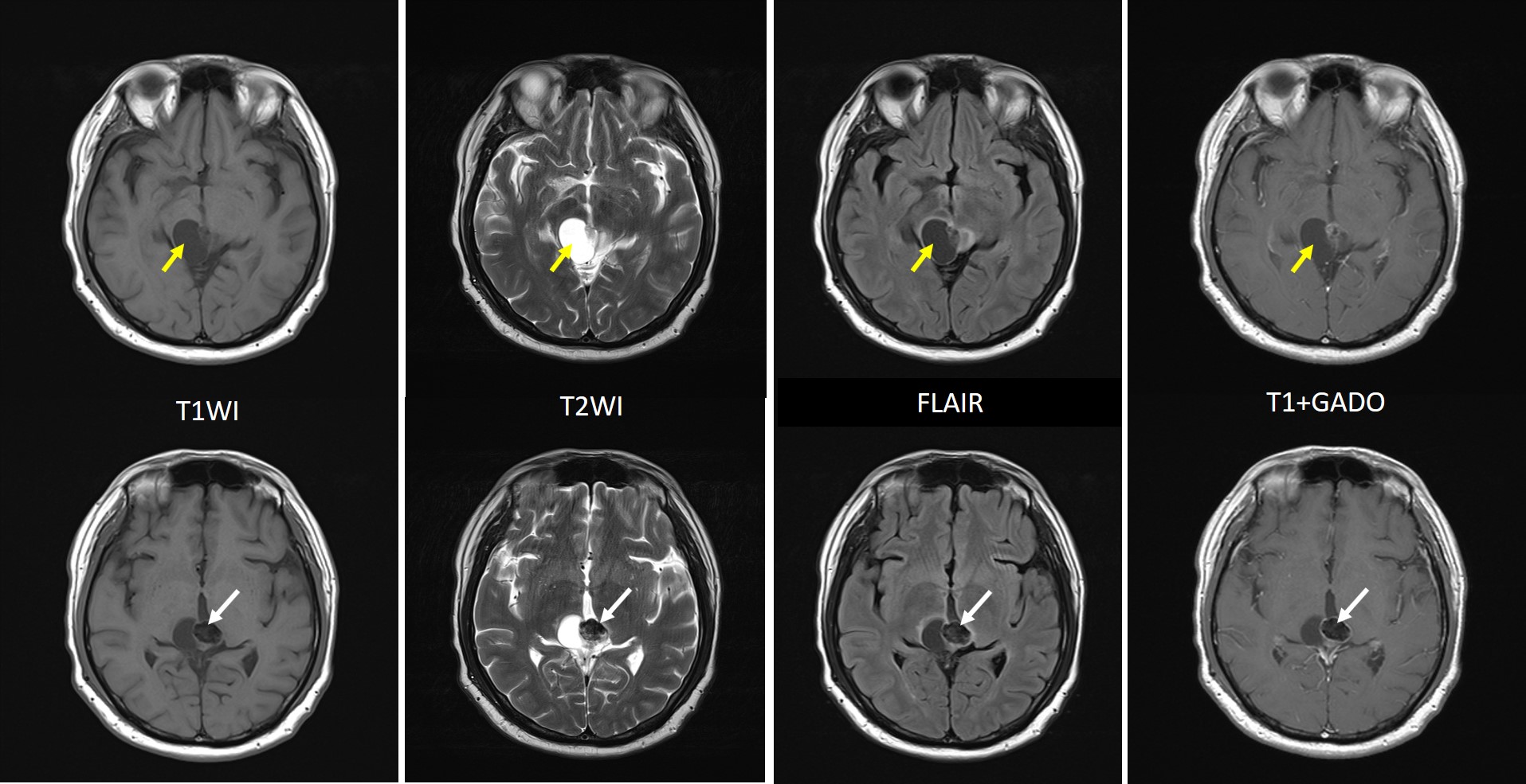 pineal-parenchymal-tumour-of-intermediate-differentiation-radiology-cases