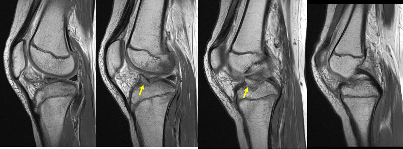 Avulsion Fracture Of ACL – Radiology Cases