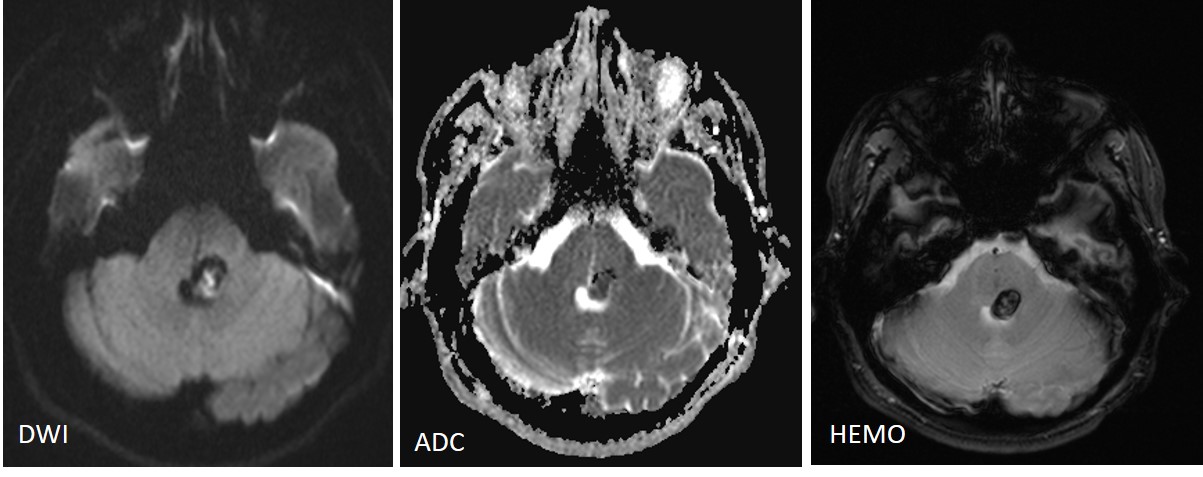 Understanding Vascular Malformations Of The Spine