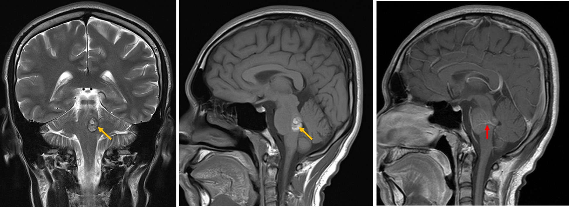 Understanding Vascular Malformations Of The Spine