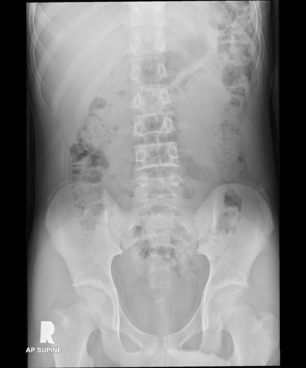 Testicular torsion Radiology Cases