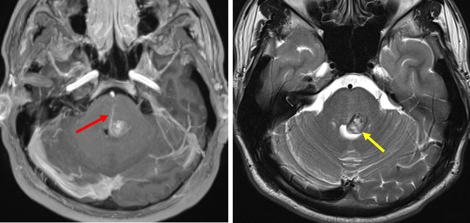 Pdf Understanding Vascular Malformation Healthclips Online