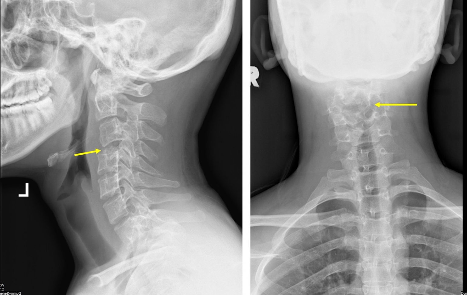 giant-cell-tumour-of-cervical-spine-radiology-cases