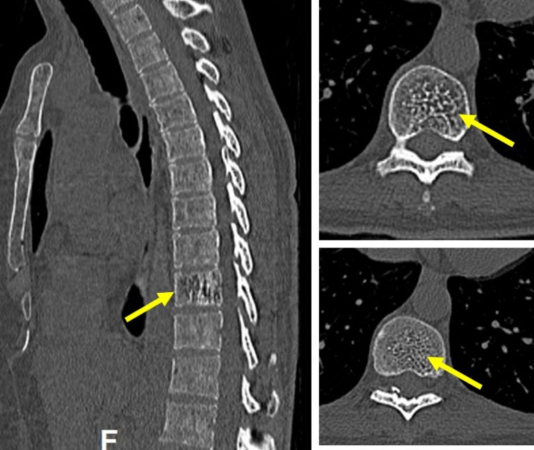“Jail bar” sign of vertebral hemangioma Radiology Cases