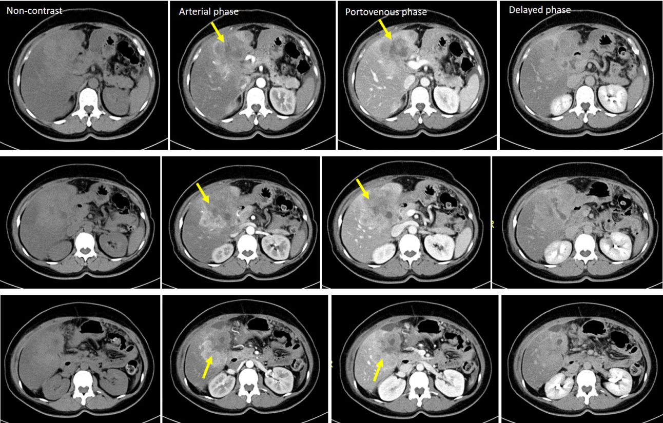 Massforming intrahepatic cholangiocarcinoma Radiology Cases