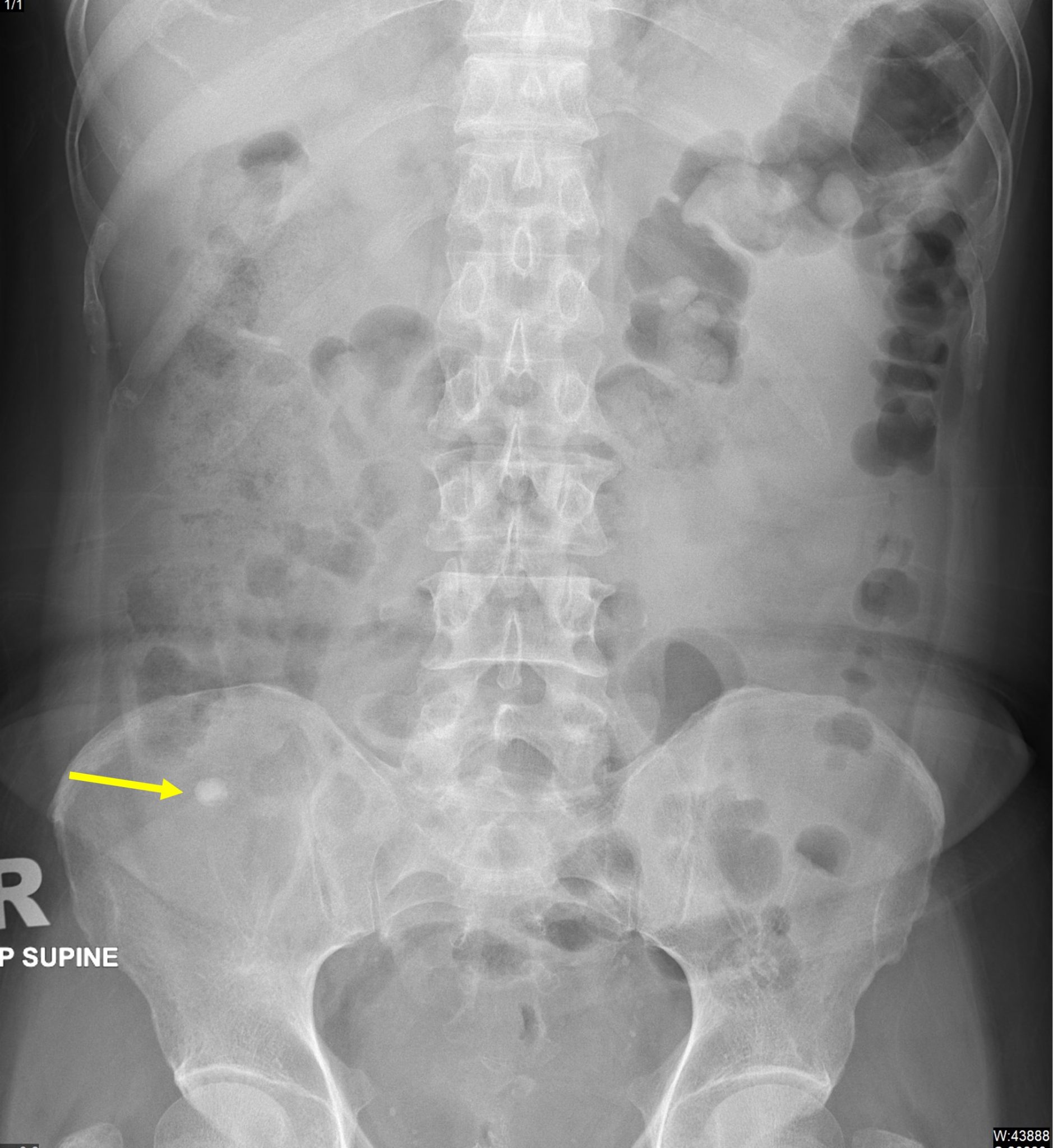 Appendicolith – Radiology Cases