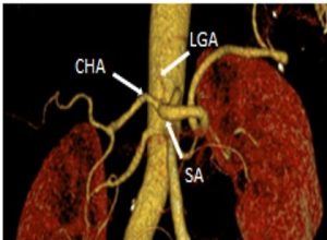 CTA Of Coeliac Trunk Variations – Radiology Cases