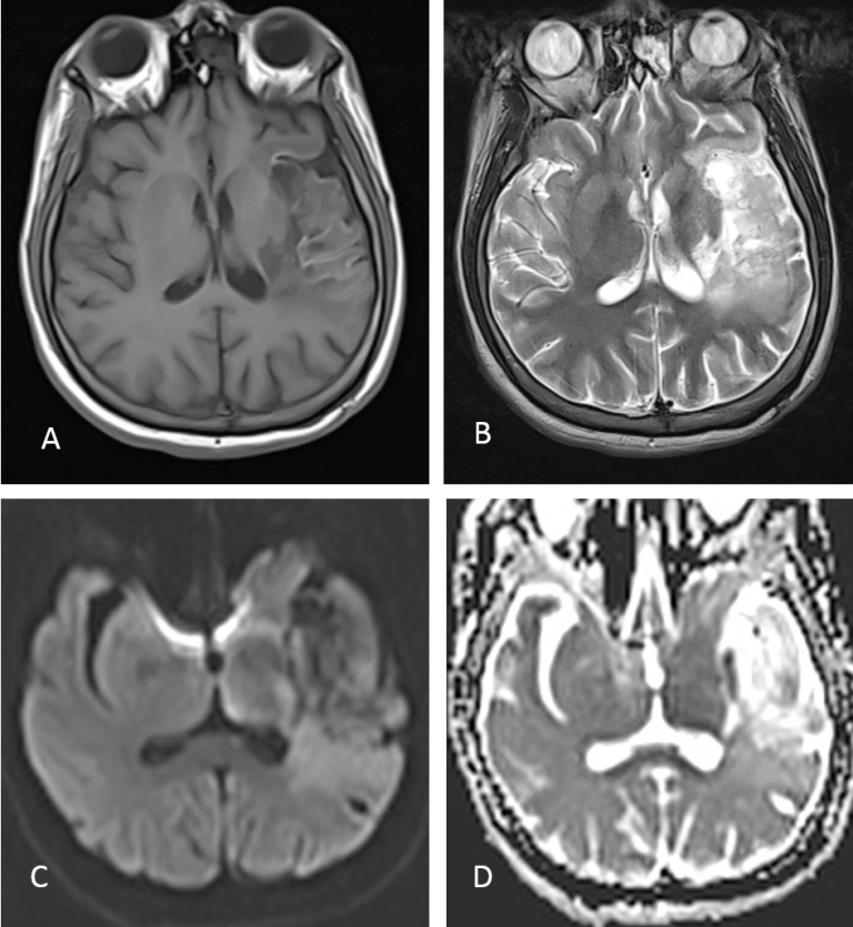 Intracranial mycotic aneurysm – Radiology Cases
