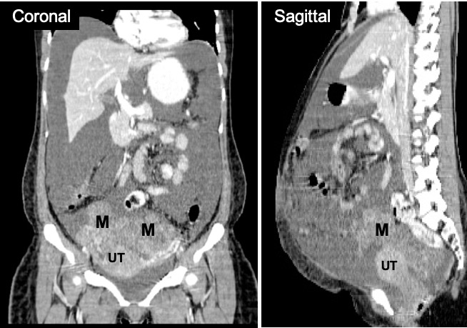Bilateral Ovarian Serous Cystadenocarcinoma Radiology Cases