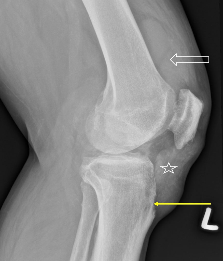 Gouty arthritis Radiology Cases