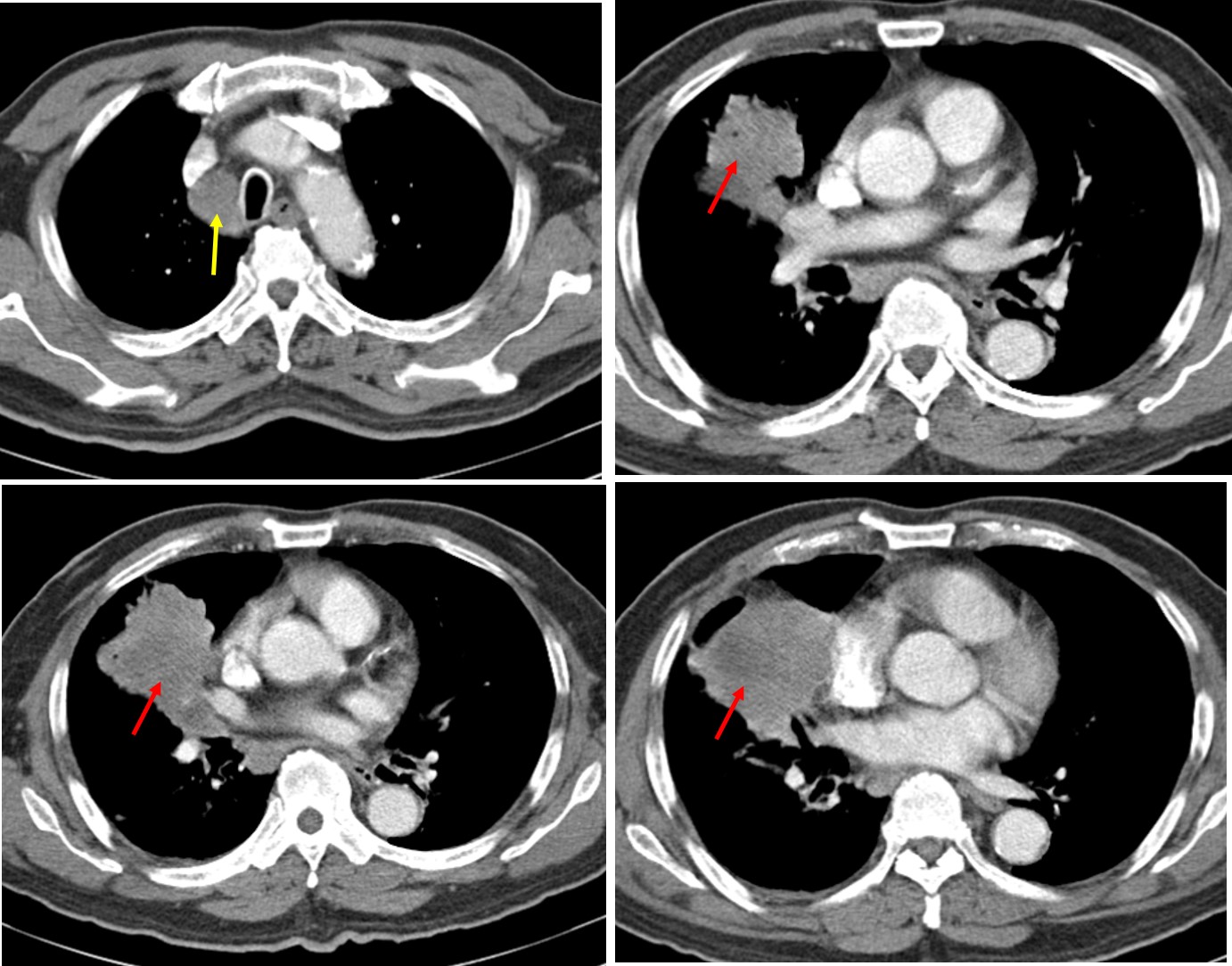 Lung cancer: squamous cell carcinoma – Radiology Cases