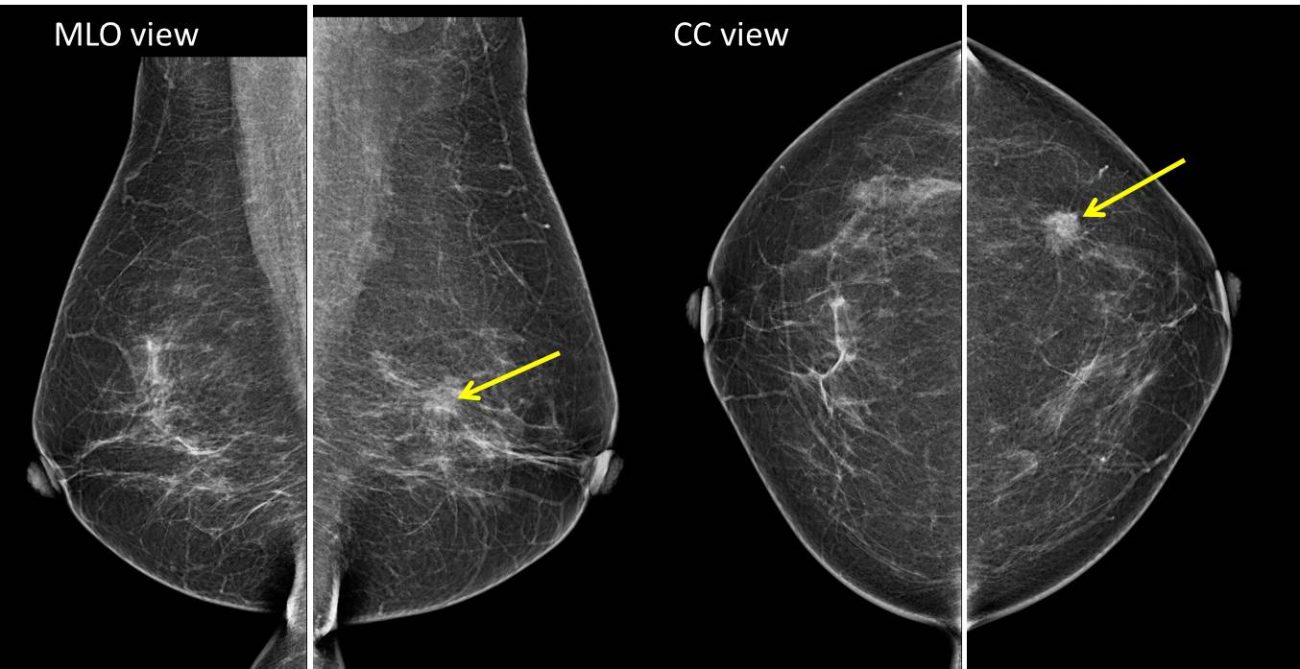 Hookwire Localisation Of Breast Lesion – Radiology Cases