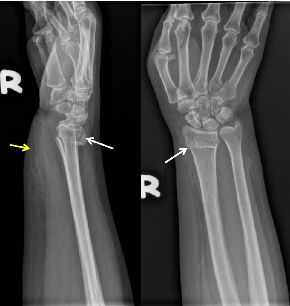 colles-fracture-radiology-cases