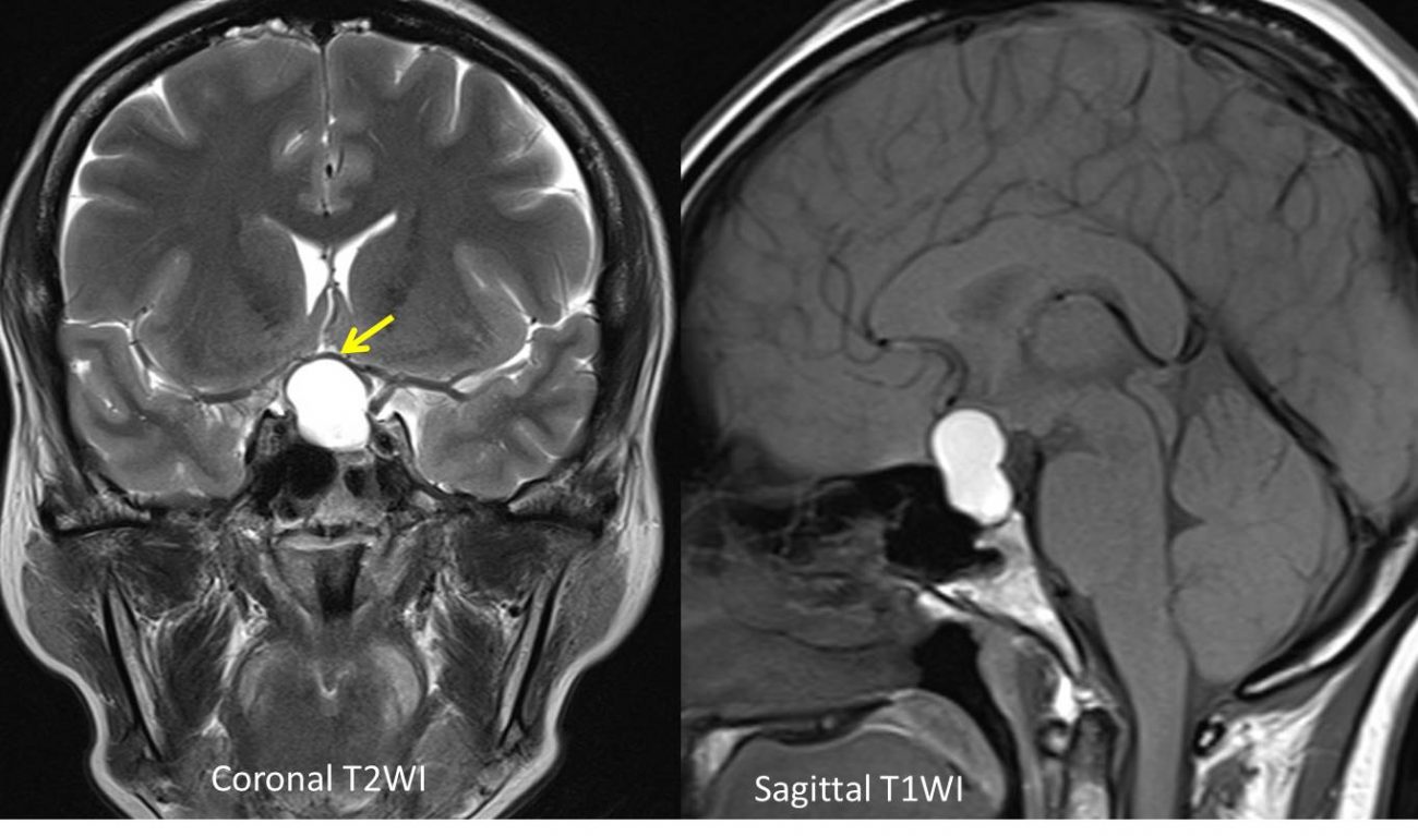 Pituitary Apoplexy Radiology Cases 