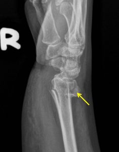 Colles fracture – Radiology Cases