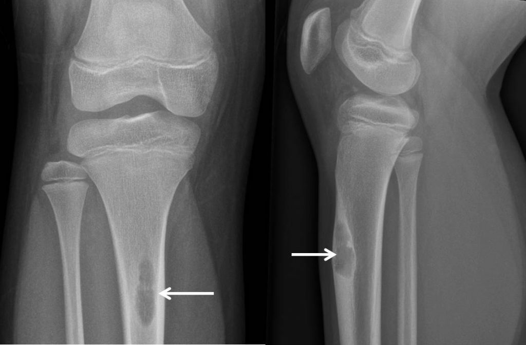 Non Ossifying Fibroma Radiology Cases