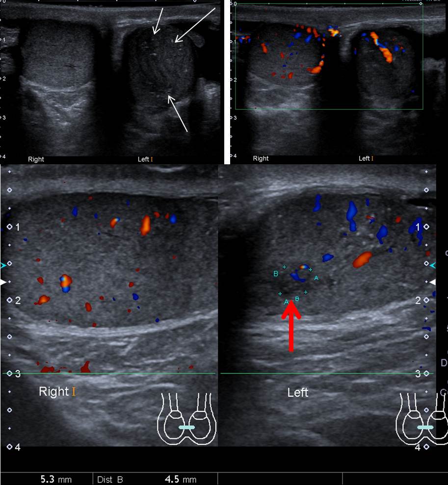 Testicular seminoma – Radiology Cases