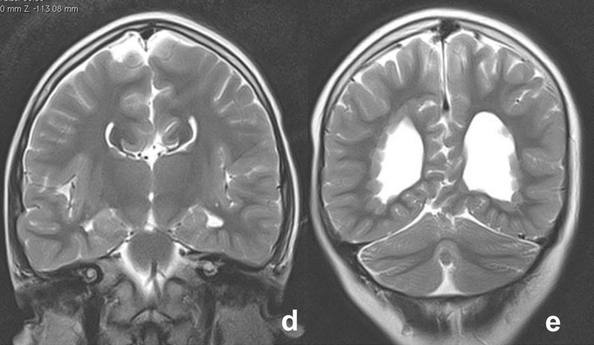 Agenesis Of Corpus Callosum Radiology Cases