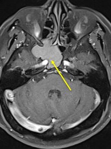 Mucocele – Radiology Cases