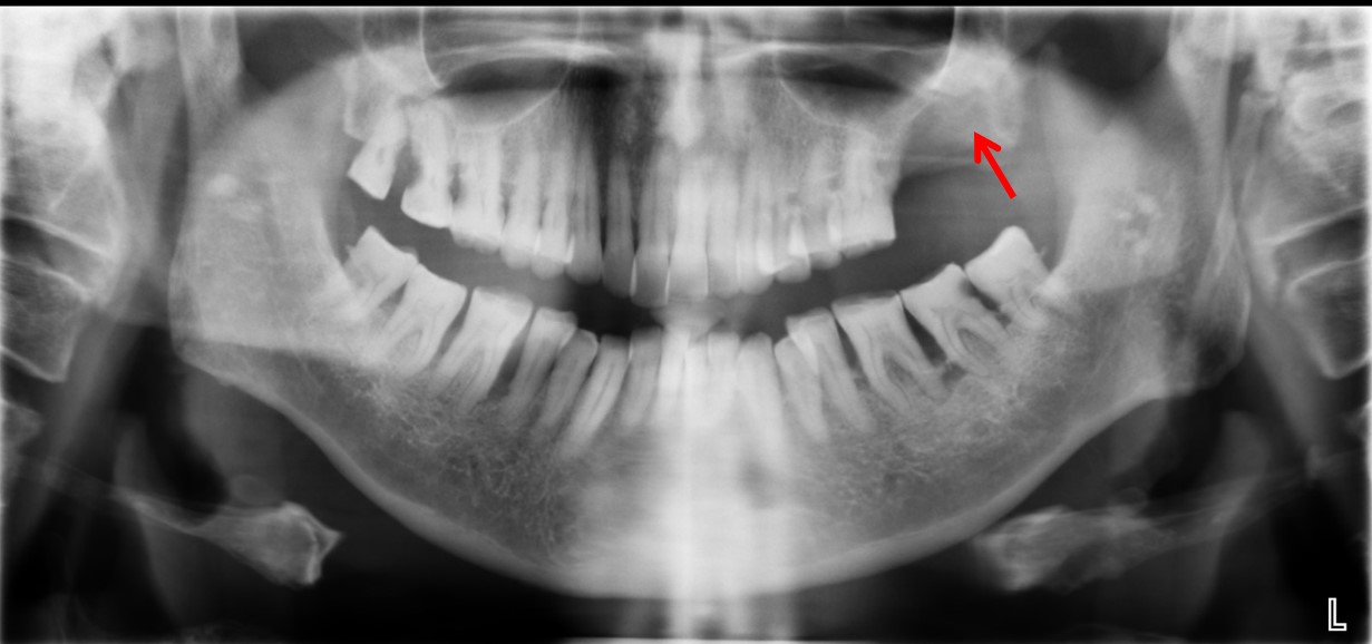 Oral squamous cell carcinoma – Radiology Cases