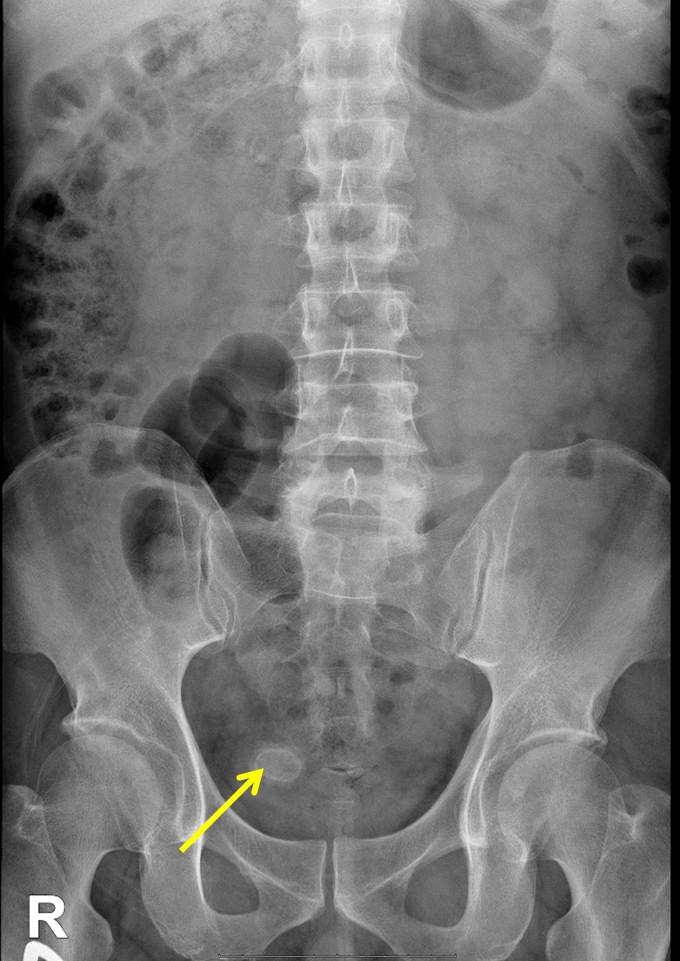 primary-urinary-bladder-calculus-radiology-cases