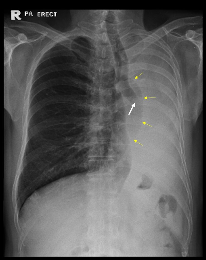 Opaque hemithorax with ipsilateral mediastinal shift – Radiology Cases