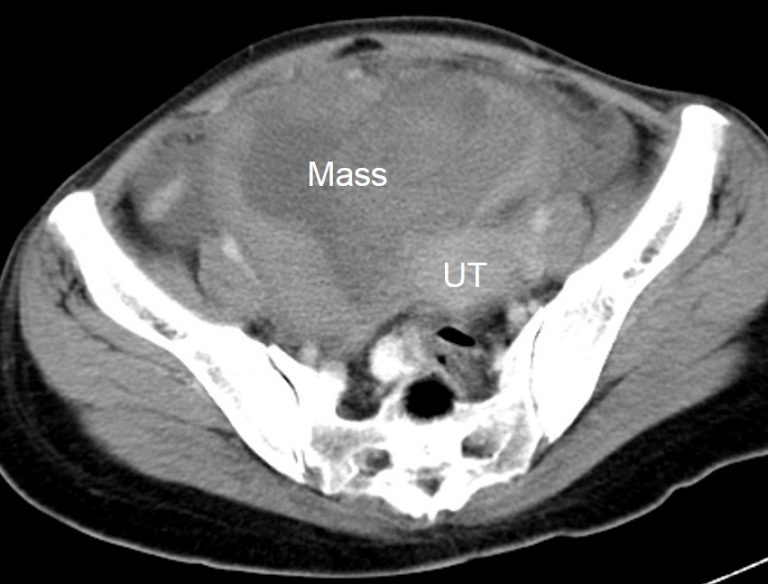 Clear Cell Carcinoma Of Both Ovaries Radiology Cases