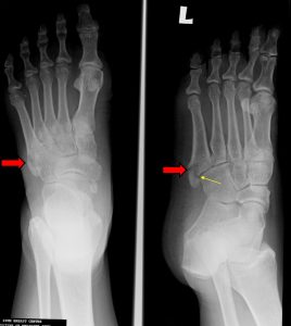 Pseudo-Jones fracture – Radiology Cases