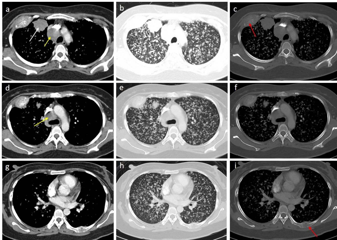 Adenocarcinoma In Situ Of Lung – URNKVL