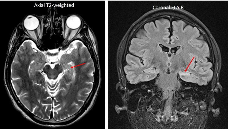 Mesial temporal sclerosis – Radiology Cases