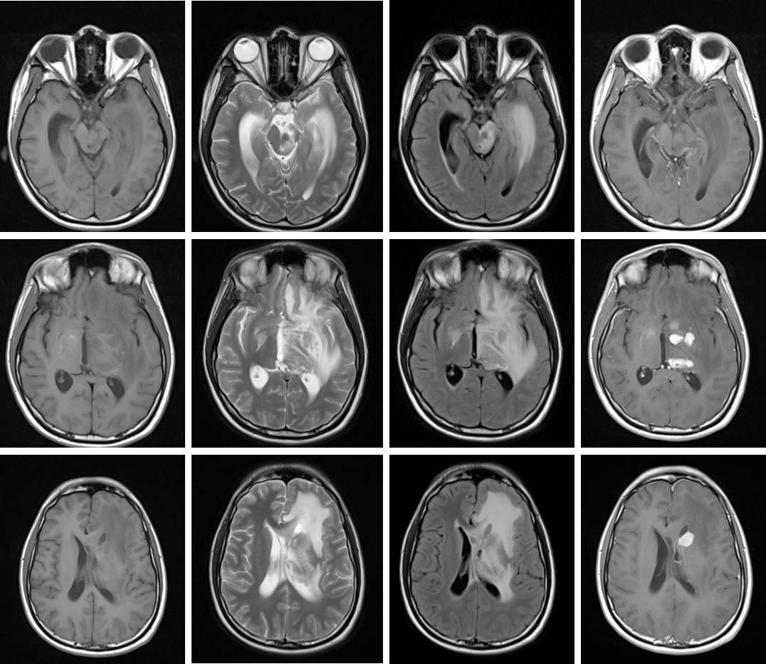 Tuberculous encephalopathy – Radiology Cases