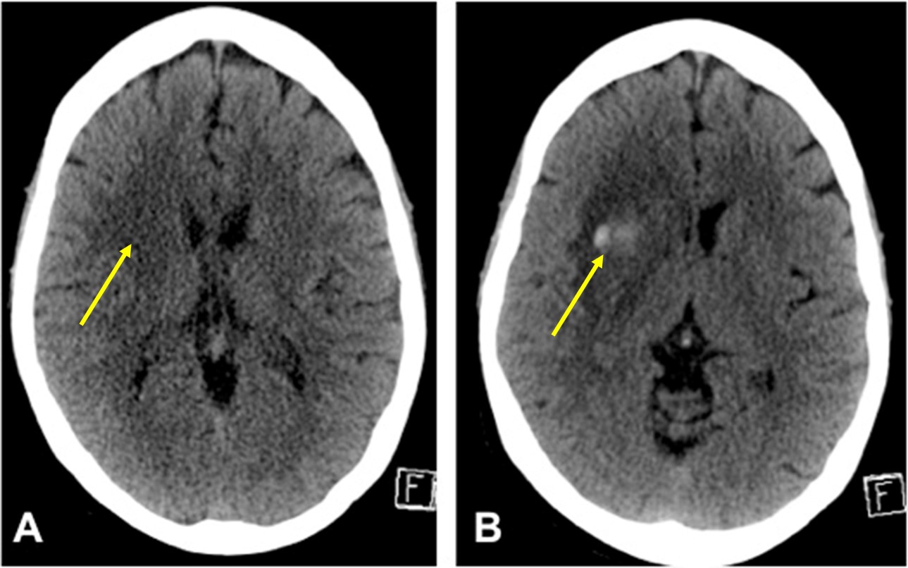 Hemorrhagic transformation of cerebral infarct – Radiology Cases