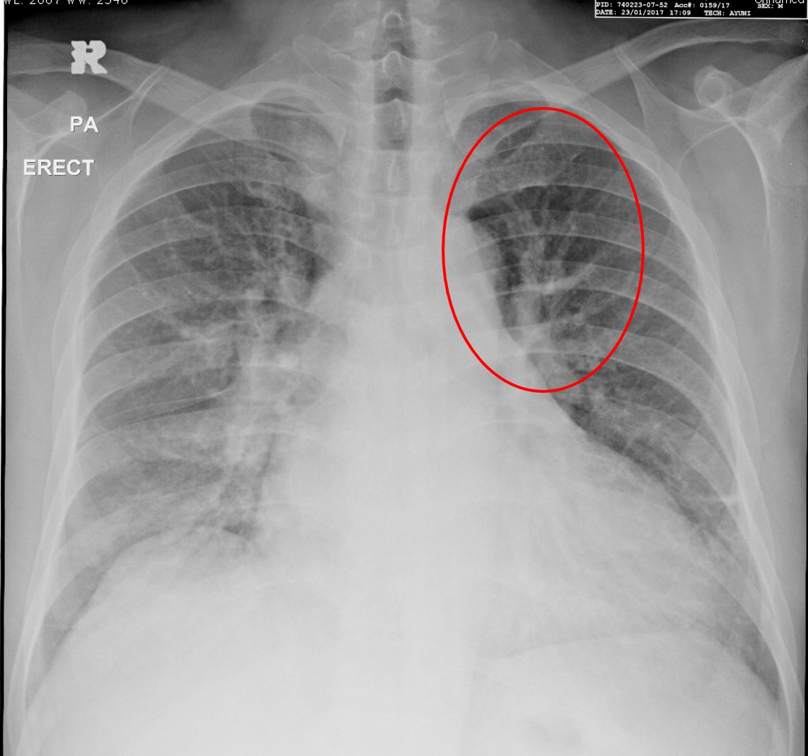 Upper Lobe Diversion Radiology Cases