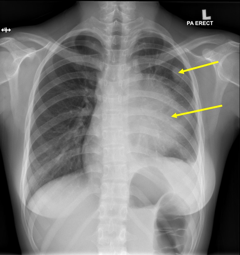 Mediastinal mass – Radiology Cases