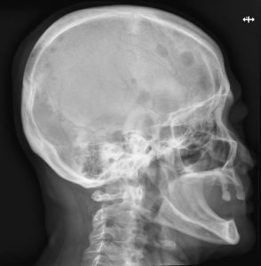 Lytic lesions in the skull – Radiology Cases