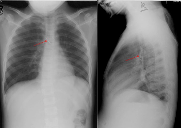 Foreign body in trachea – Radiology Cases