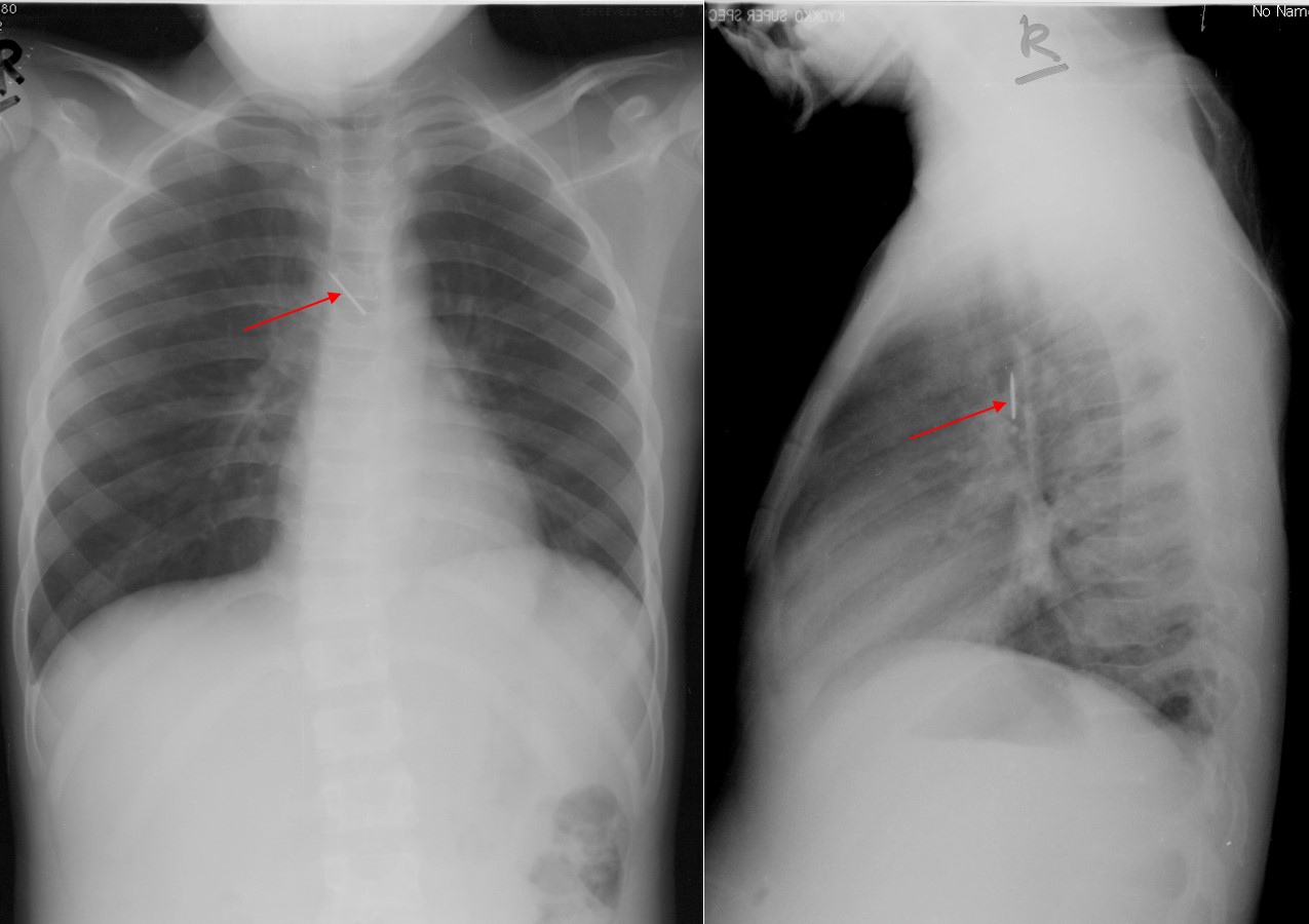 foreign-body-in-trachea-radiology-cases