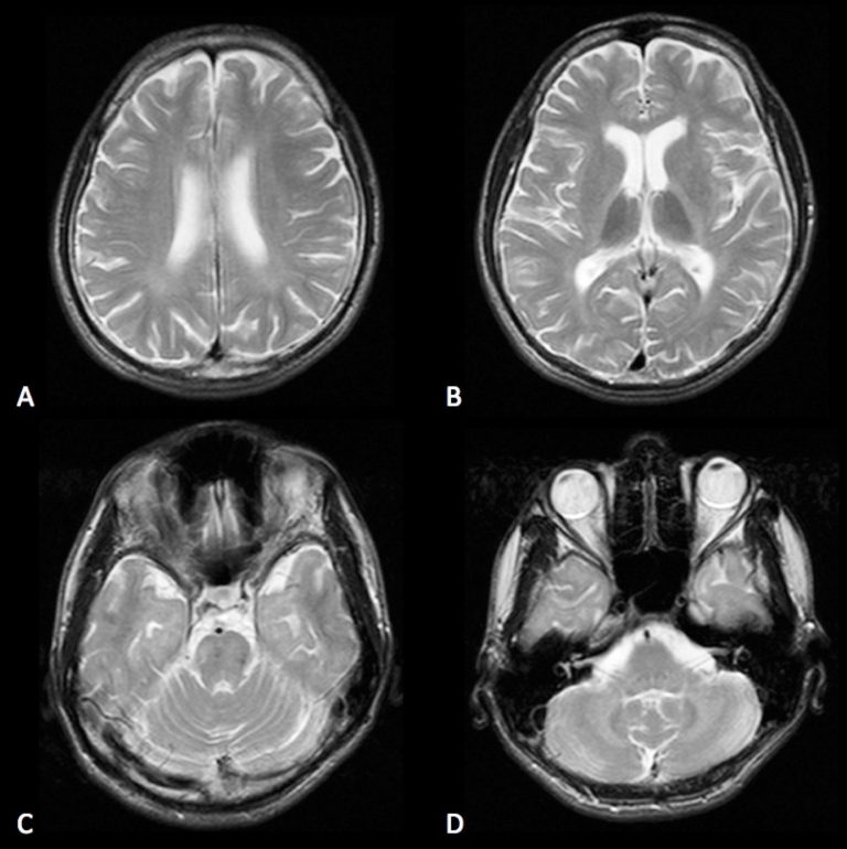 Chronic Toluene-induced encephalopathy – Radiology Cases