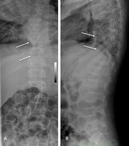 Disseminated tuberculosis – Radiology Cases