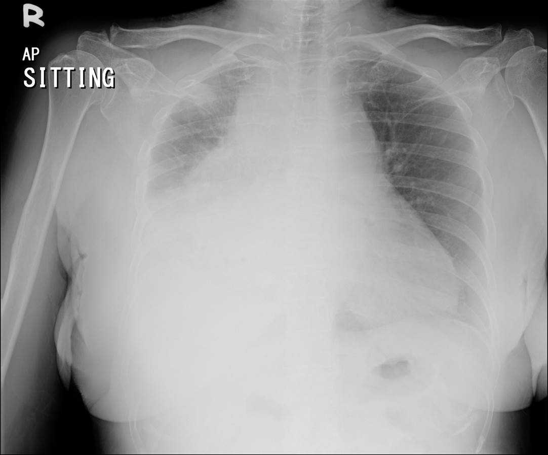 Widened Mediastinum – Radiology Cases