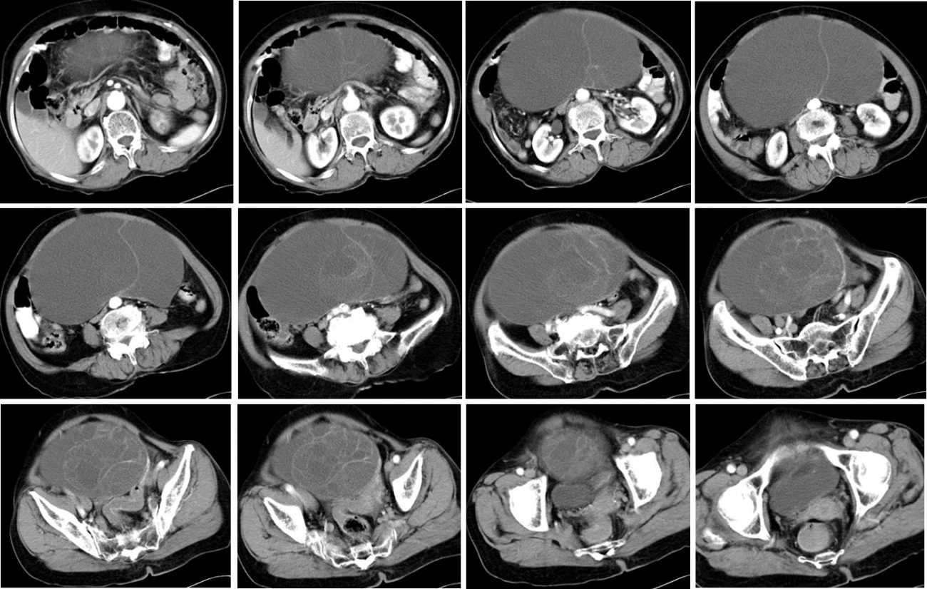 Ovarian Mucinous Cystadenoma Radiology Cases