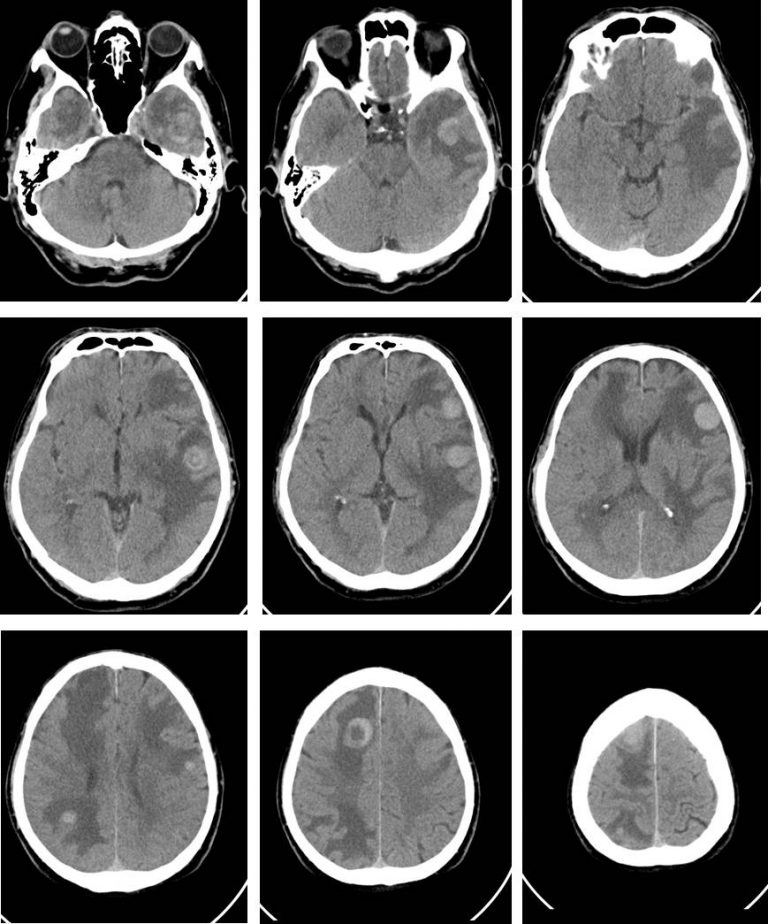 Hyperdense cerebral metastasis – Radiology Cases