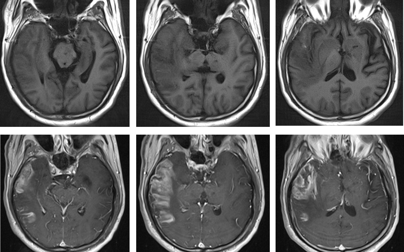 MCA infarction or HSV encephalitis? – Radiology Cases